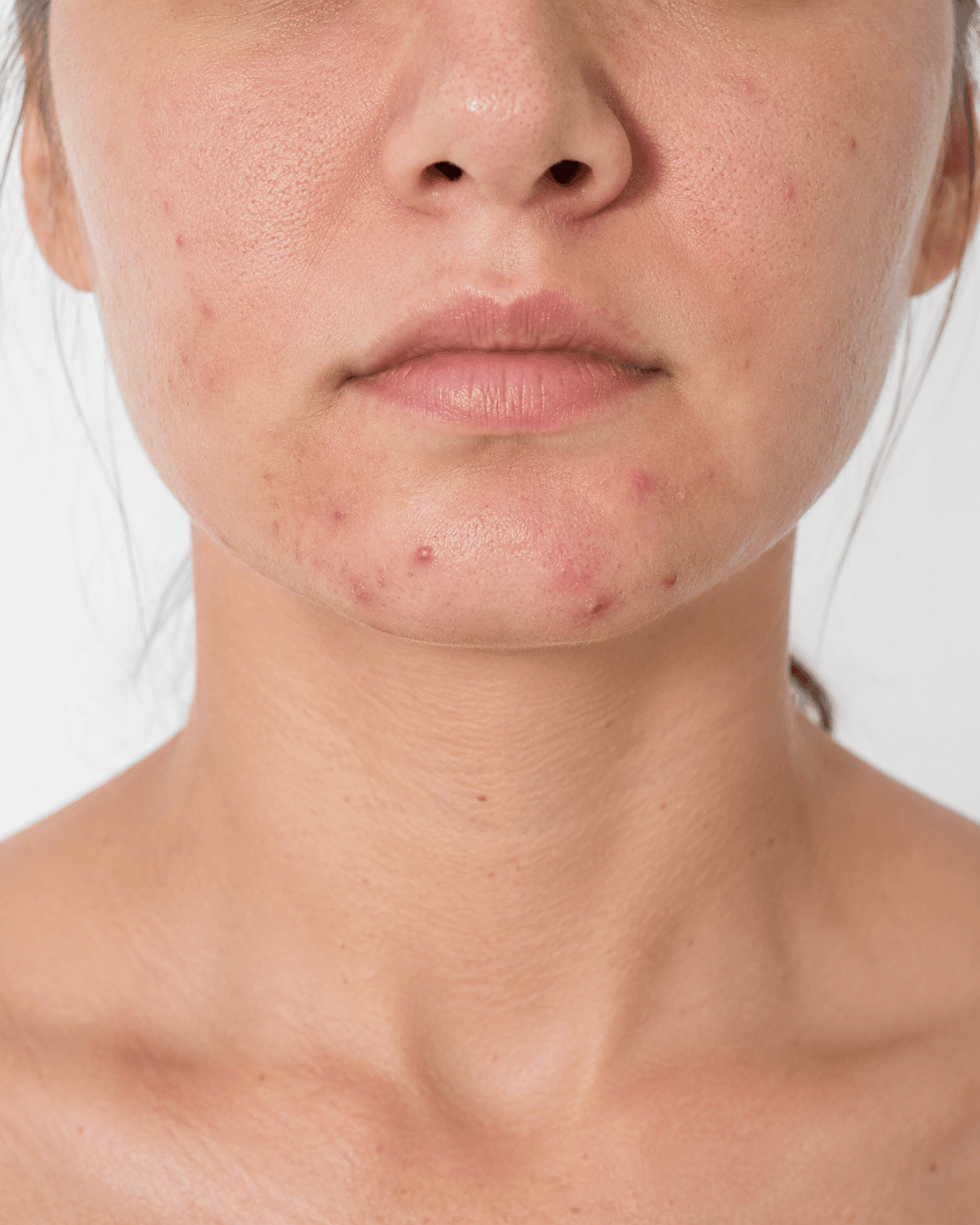Before — Acne-prone · Reactive