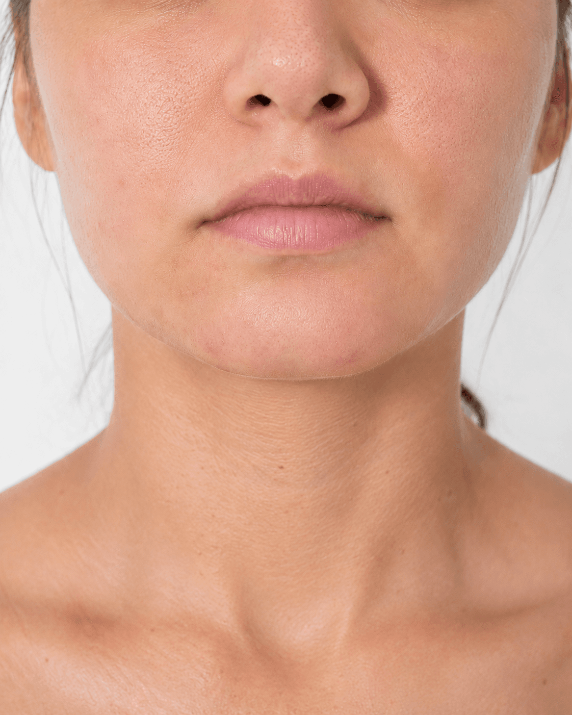 After — Acne-prone · Reactive
