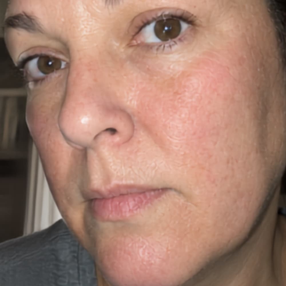 Sarah B., after — visibly calmer skin