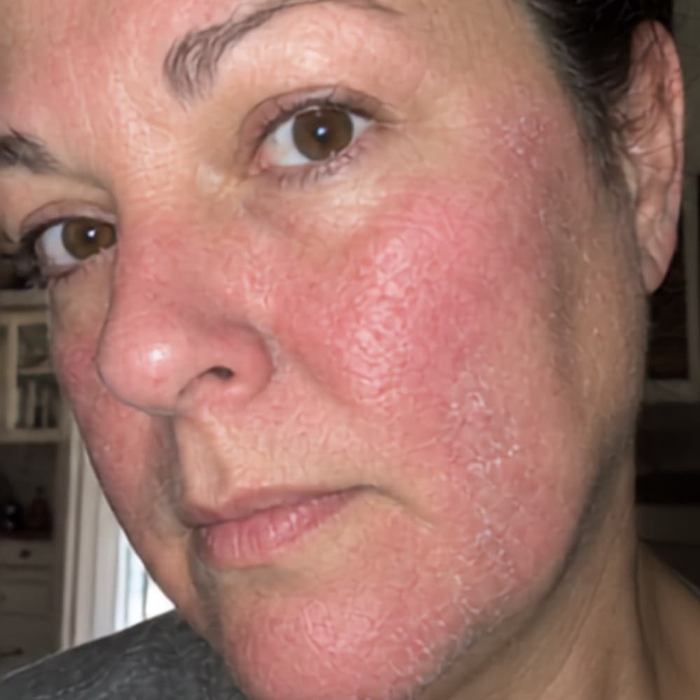 Sarah B., before — visibly calmer skin